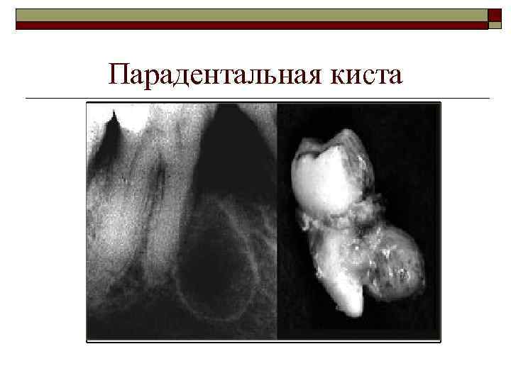 Парадентальная киста 