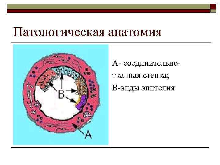 Патологическая анатомия А- соединительнотканная стенка; В-виды эпителия 