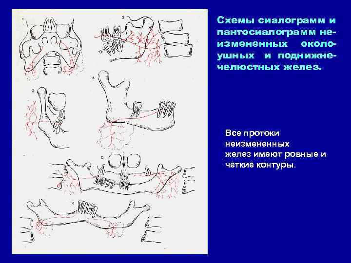 Схемы сиалограмм и пантосиалограмм неизмененных околоушных и поднижнечелюстных желез. Все протоки неизмененных желез имеют