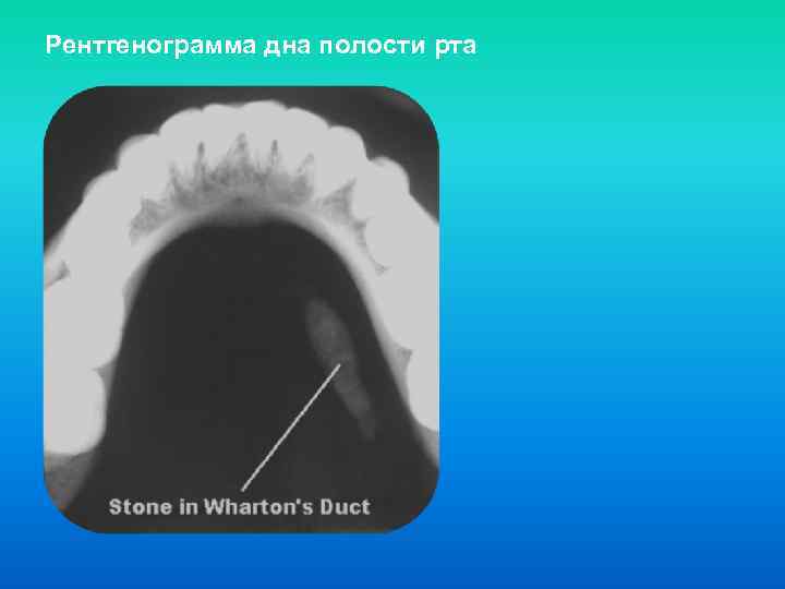 Кт ротовой полости. Рентгенограмма дна полости рта. Внутриротовая рентгенография дна полости рта вприкус. Окклюзионная рентгенограмма. Внутриротовая рентгенография в прикус.