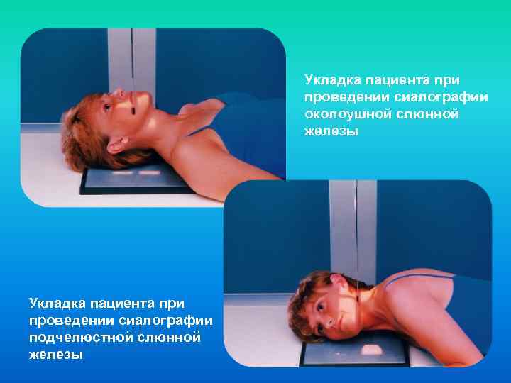 Укладка пациента при проведении сиалографии околоушной слюнной железы Укладка пациента при проведении сиалографии подчелюстной