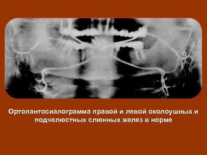 Ортопантосиалограмма правой и левой околоушных и подчелюстных слюнных желез в норме 