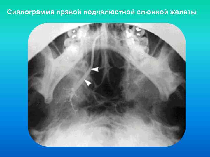 Конкременты на сиалограммах дают картину