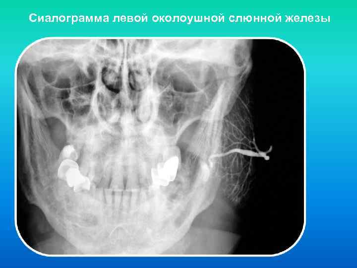 Сиалография слюнных