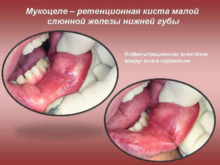 Мукоцеле – ретенционная киста малой слюнной железы нижней губы Инфильтрационная анестезия вокруг очага поражения