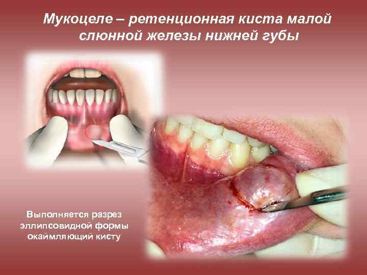 Мукоцеле – ретенционная киста малой слюнной железы нижней губы Выполняется разрез эллипсовидной формы окаймляющий