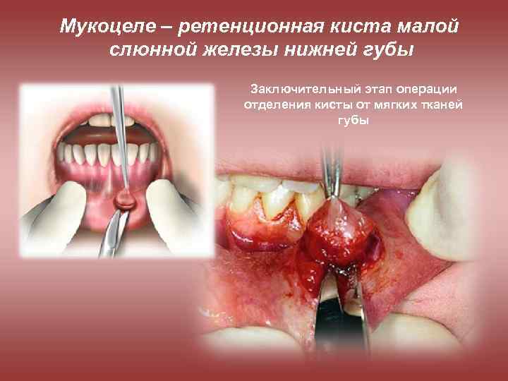 Мукоцеле – ретенционная киста малой слюнной железы нижней губы Заключительный этап операции отделения кисты