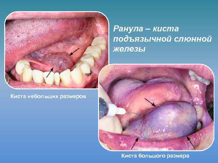 Ранула – киста подъязычной слюнной железы Киста небольших размеров Киста большого размера 