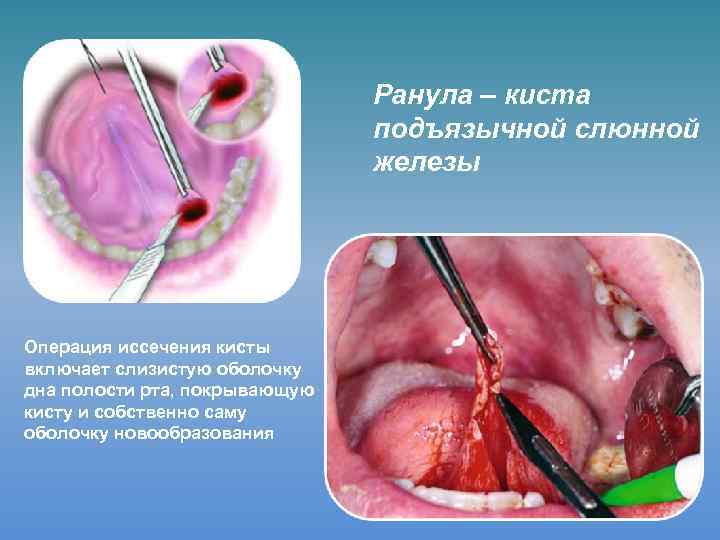 Ранула – киста подъязычной слюнной железы Операция иссечения кисты включает слизистую оболочку дна полости