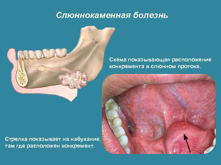 Слюннокаменная болезнь Схема показывающая расположение конкремента в слюнном протоке. Стрелка показывает на набухание, там