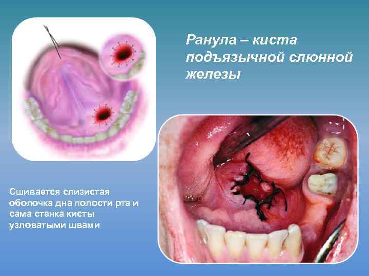 Ранула – киста подъязычной слюнной железы Сшивается слизистая оболочка дна полости рта и сама