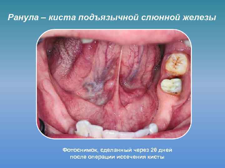 Ранула – киста подъязычной слюнной железы Фотоснимок, сделанный через 20 дней после операции иссечения