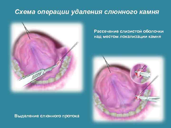 Схема операции удаления слюнного камня Рассечение слизистой оболочки над местом локализации камня Выделение слюнного