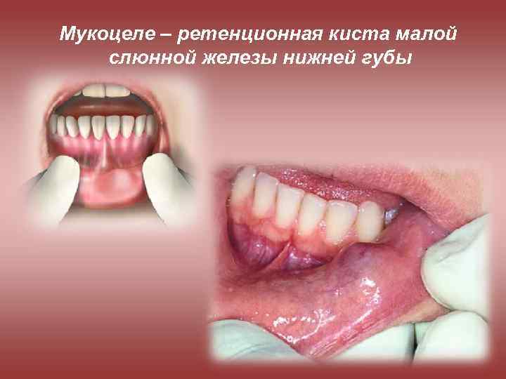 Мукоцеле – ретенционная киста малой слюнной железы нижней губы 