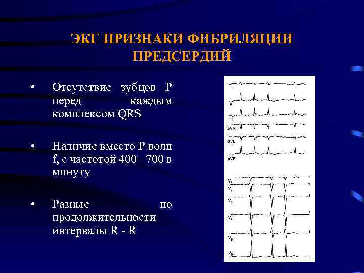 ЭКГ ПРИЗНАКИ ФИБРИЛЯЦИИ ПРЕДСЕРДИЙ • Отсутствие зубцов P перед каждым комплексом QRS • Наличие