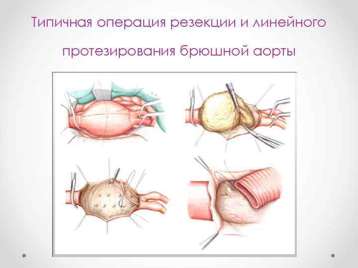 Типичная операция резекции и линейного протезирования брюшной аорты 