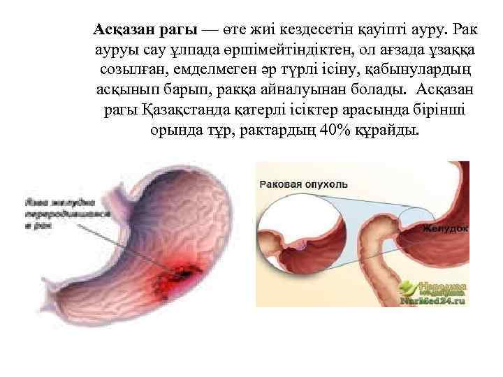 Асқазан рагы — өте жиі кездесетін қауіпті ауру. Рак ауруы сау ұлпада өршімейтіндіктен, ол