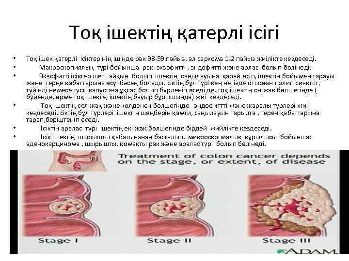 Тоқ ішектің қатерлі ісігі • • Тоқ ішек қатерлі ісіктерінің ішінде рак 98 -99