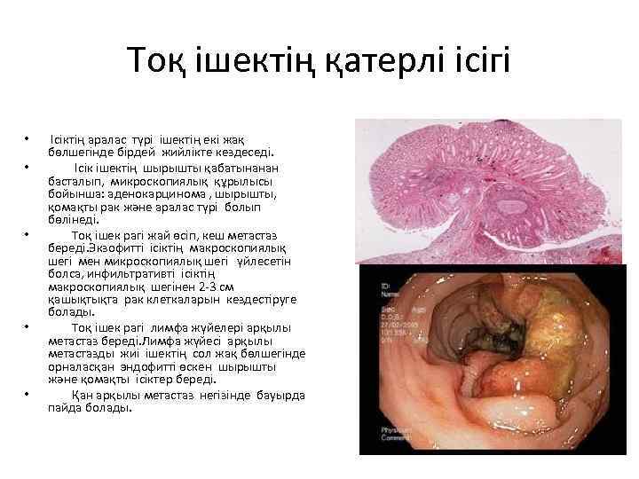 Тоқ ішектің қатерлі ісігі • • • Ісіктің аралас түрі ішектің екі жақ бөлшегінде