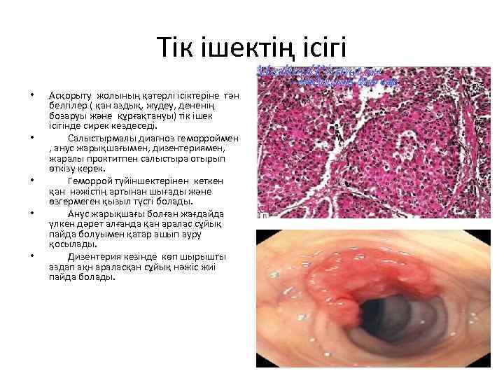 Тік ішектің ісігі • • • Асқорыту жолының қатерлі ісіктеріне тән белгілер ( қан
