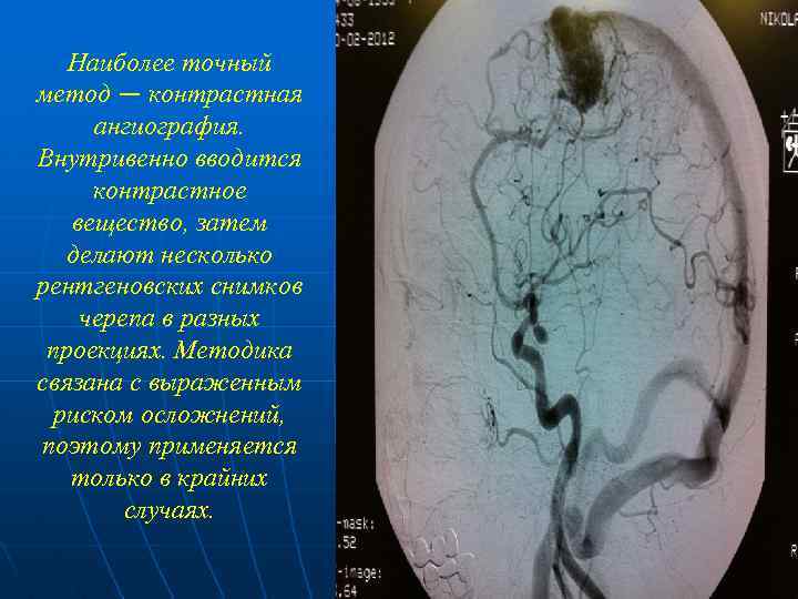 Наиболее точный метод — контрастная ангиография. Внутривенно вводится контрастное вещество, затем делают несколько рентгеновских