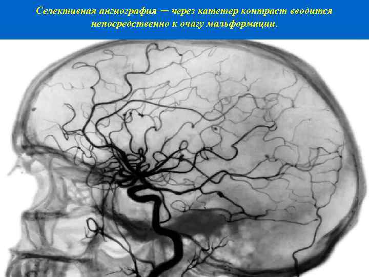 Селективная ангиография — через катетер контраст вводится непосредственно к очагу мальформации. 