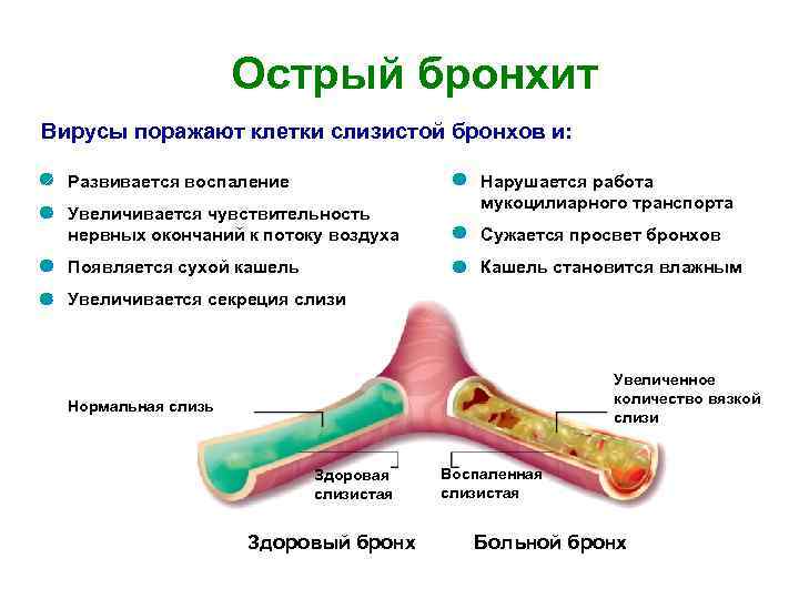 Острый бронхит Вирусы поражают клетки слизистой бронхов и: Развивается воспаление Увеличивается чувствительность нервных окончаний