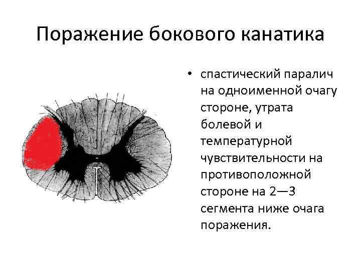 Поражение бокового канатика • спастический паралич на одноименной очагу стороне, утрата болевой и температурной