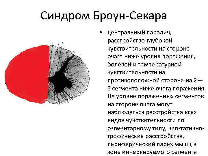 Синдром Броун-Секара • центральный паралич, расстройство глубокой чувствительности на стороне очага ниже уровня поражения,