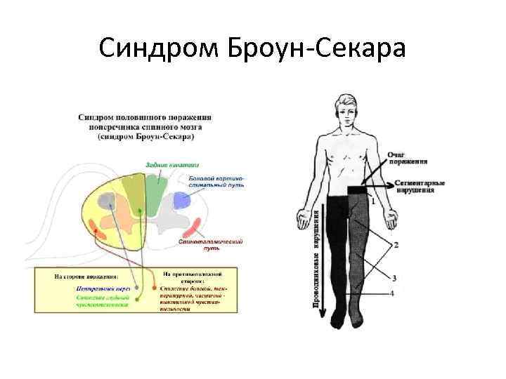 Синдром Броун-Секара 