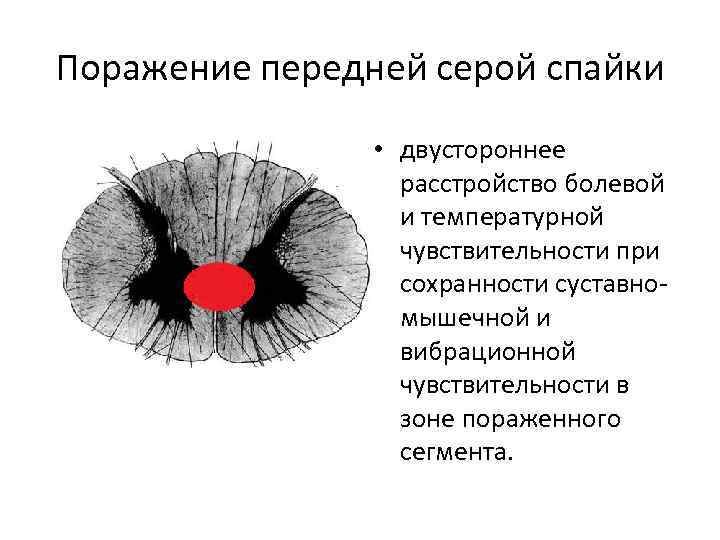 Поражение передней серой спайки • двустороннее расстройство болевой и температурной чувствительности при сохранности суставномышечной