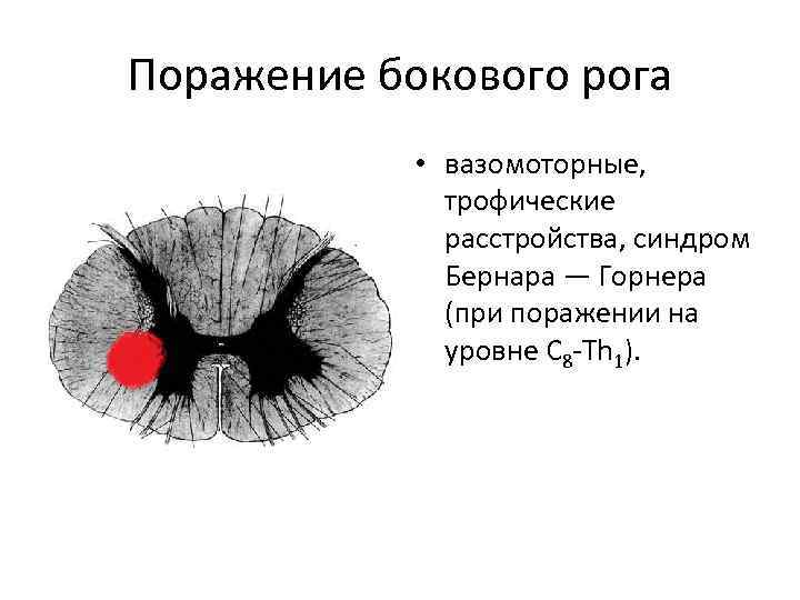 Поражение бокового рога • вазомоторные, трофические расстройства, синдром Бернара — Горнера (при поражении на