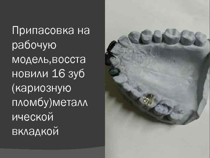 Припасовка на рабочую модель, восста новили 16 зуб (кариозную пломбу)металл ической вкладкой 