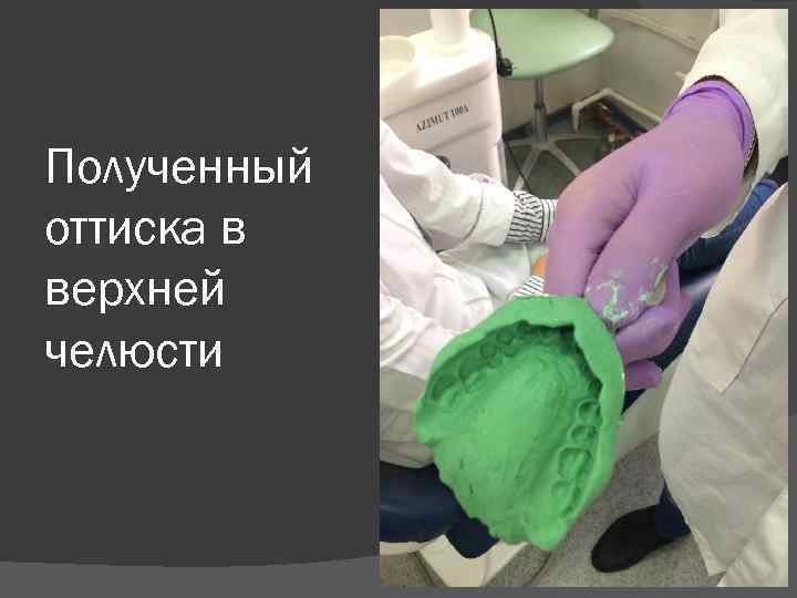 Полученный оттиска в верхней челюсти 