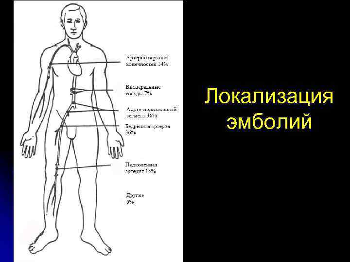 Локализация эмболий 