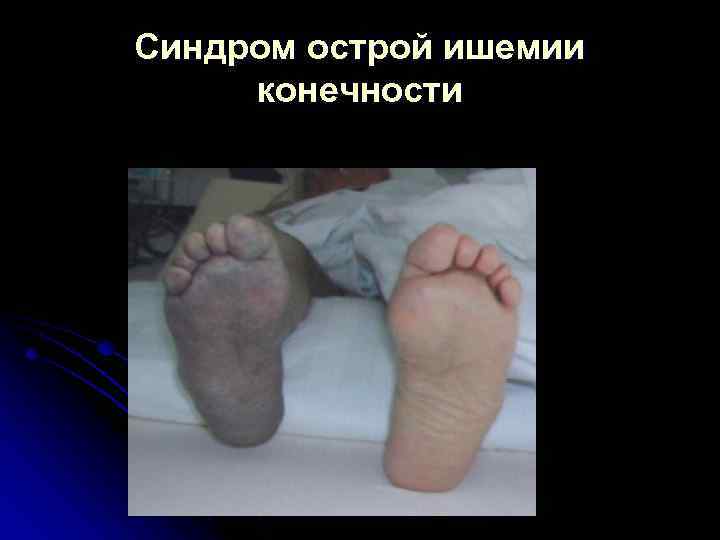 Синдром острой ишемии конечности 