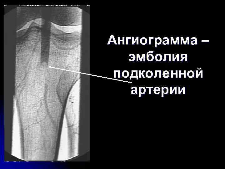 Острая артериальная непроходимость презентация хирургия