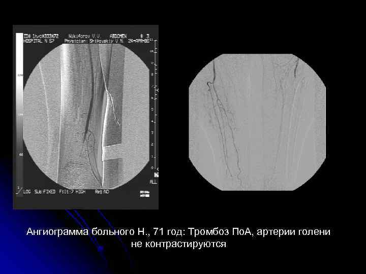 Ангиограмма больного Н. , 71 год: Тромбоз По. А, артерии голени не контрастируются 