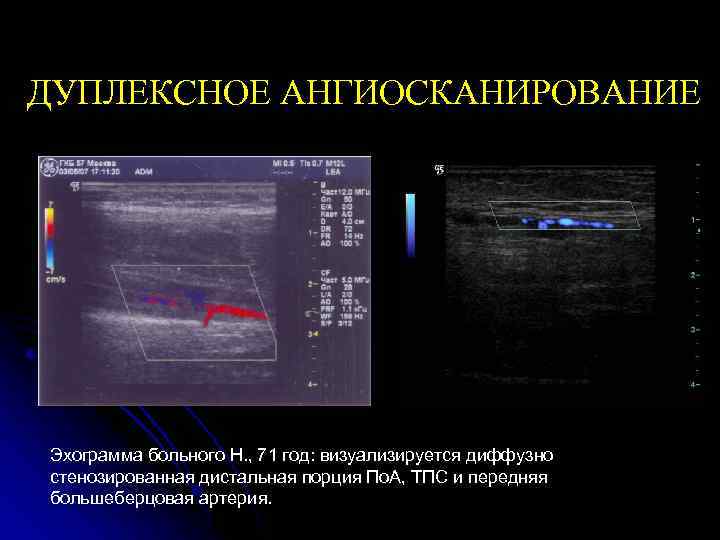 ДУПЛЕКСНОЕ АНГИОСКАНИРОВАНИЕ Эхограмма больного Н. , 71 год: визуализируется диффузно стенозированная дистальная порция По.