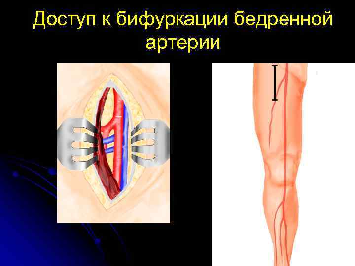 Доступ к бифуркации бедренной артерии 