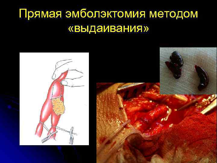 Прямая эмболэктомия методом «выдаивания» 