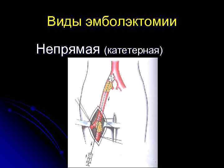 Острая артериальная непроходимость презентация хирургия