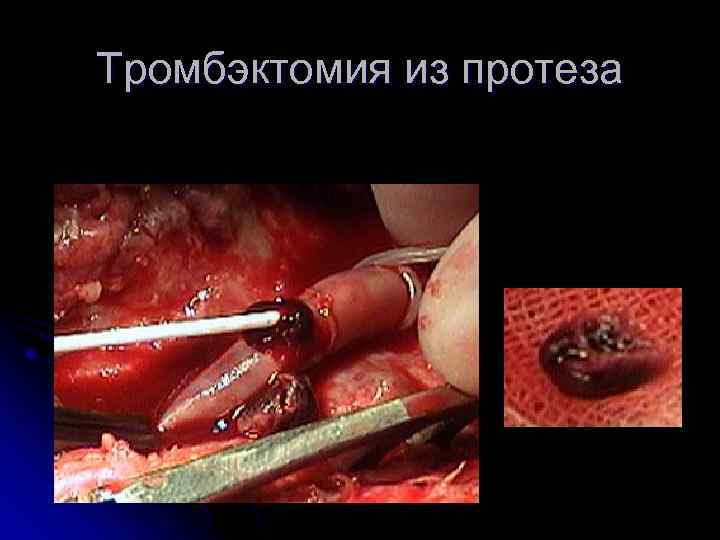 Тромбэктомия из протеза 