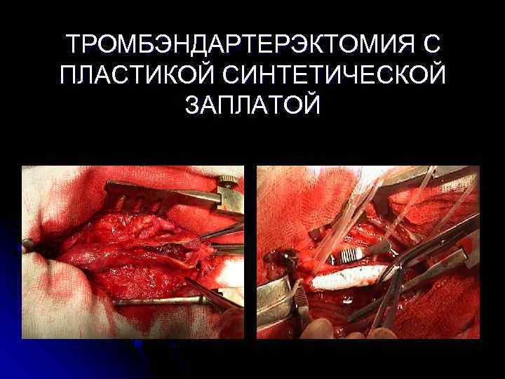 ТРОМБЭНДАРТЕРЭКТОМИЯ С ПЛАСТИКОЙ СИНТЕТИЧЕСКОЙ ЗАПЛАТОЙ 