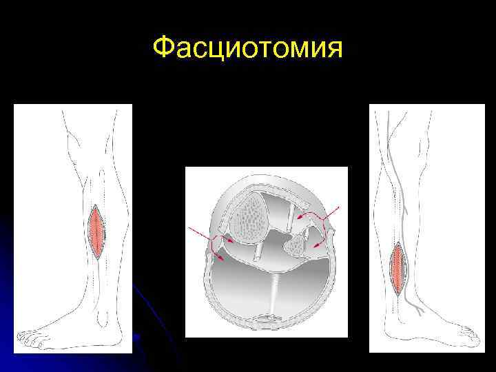 Фасциотомия 