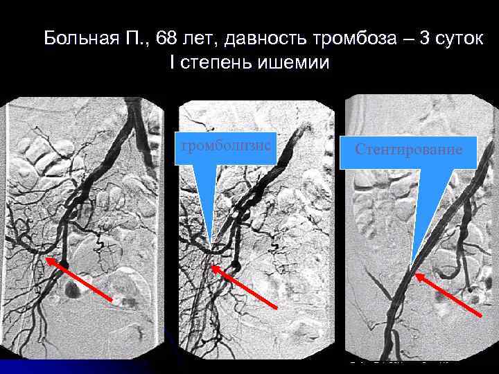 Больная П. , 68 лет, давность тромбоза – 3 суток I степень ишемии тромболизис