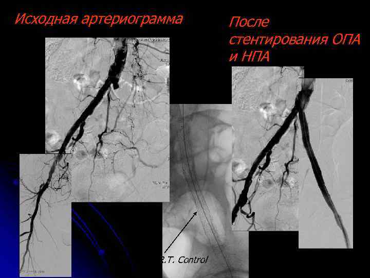 Исходная артериограмма Стент S. M. A. R. T. Control (J&J, Cordis) После cтентирования ОПА