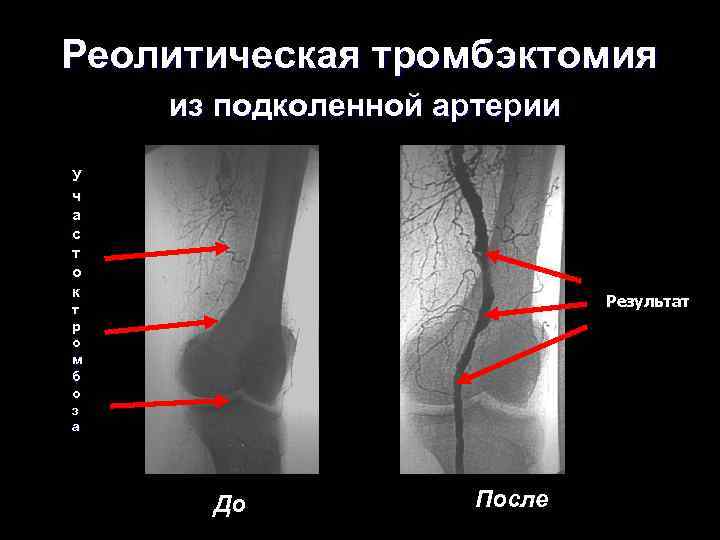 Острая артериальная непроходимость презентация хирургия