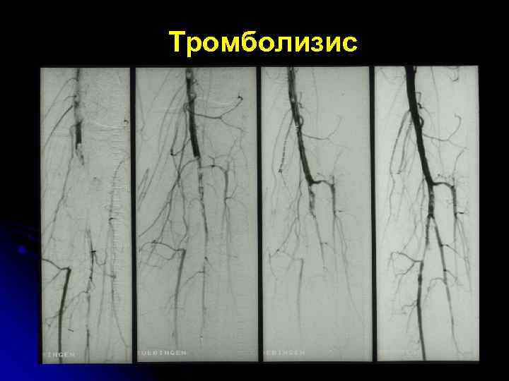 Тромболизис 