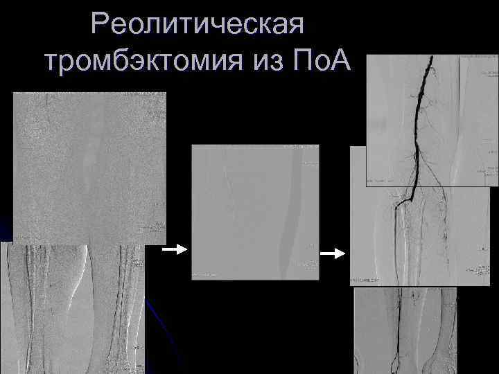Реолитическая тромбэктомия из По. А 